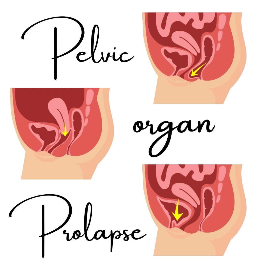 Pelvic Organ Prolapse (POP) Awareness