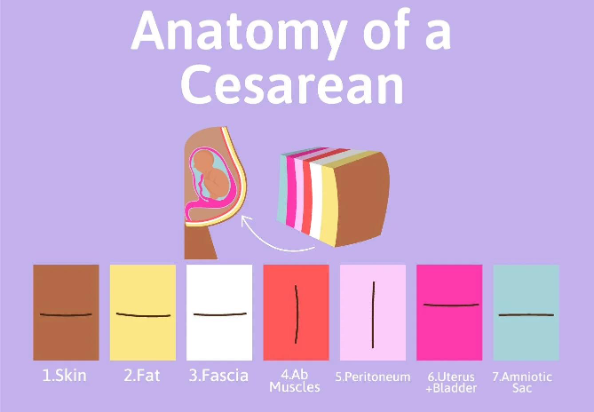 What Actually Happens During a C-Section